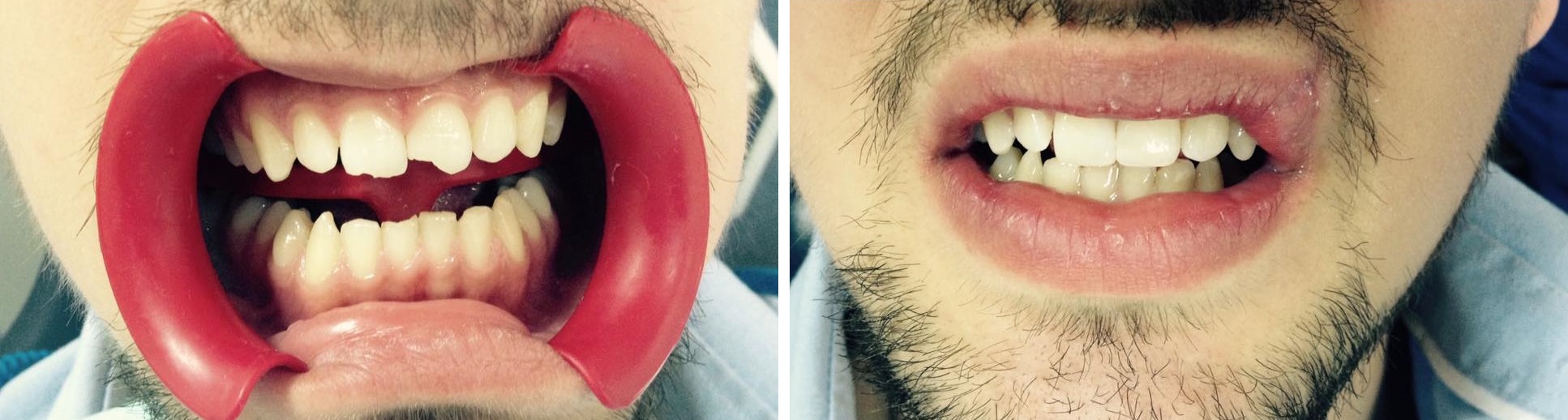 Восстановление зубов после травмы