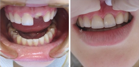 Восстановление переднего зуба