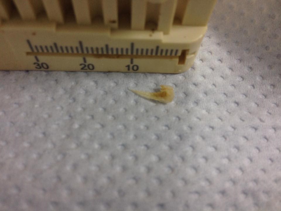 Еще немного, и зуб пришлось бы удалить