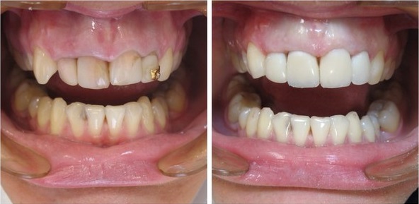 Реставрация перед свадьбой