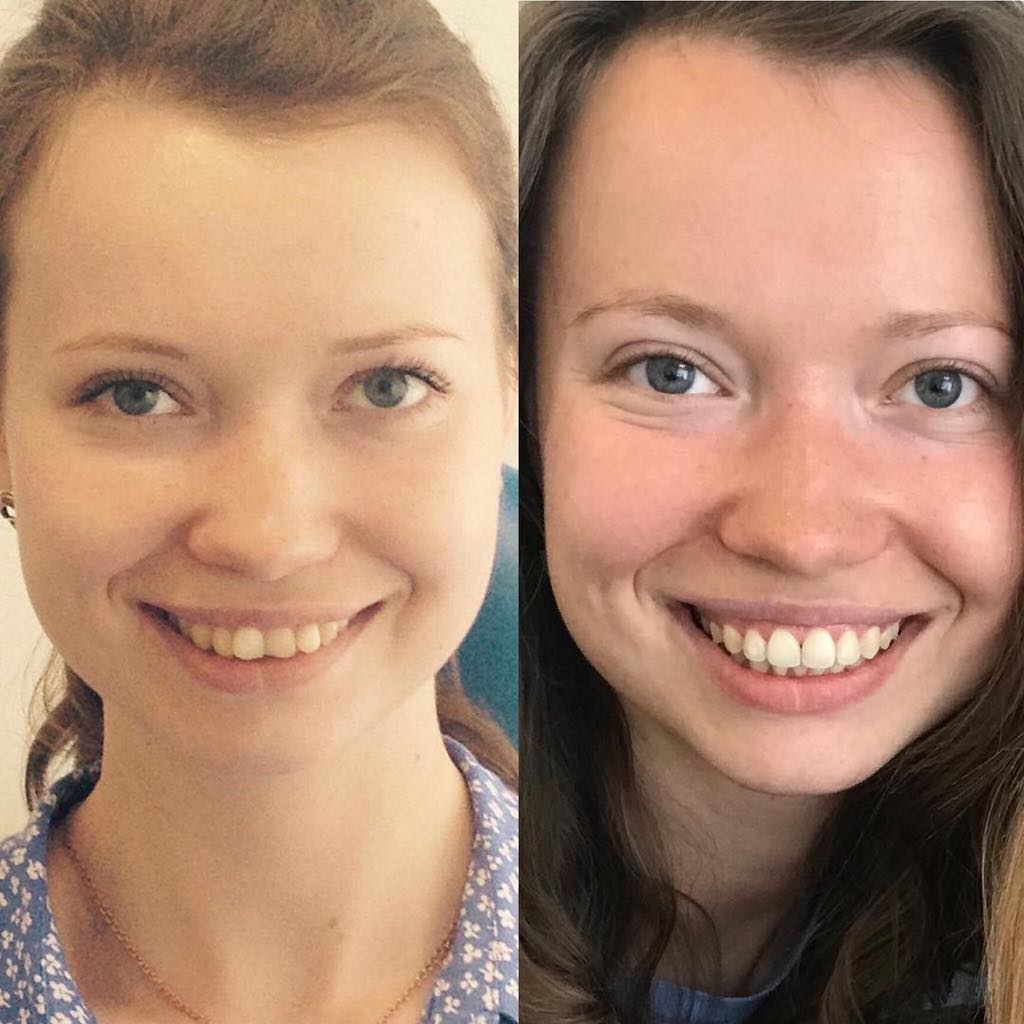 Реставрация ДО и ПОСЛЕ