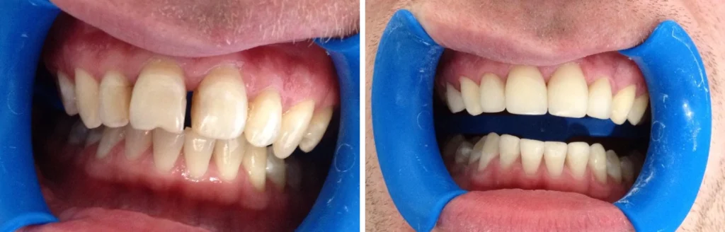 Реставрація з реконструкцією зубів