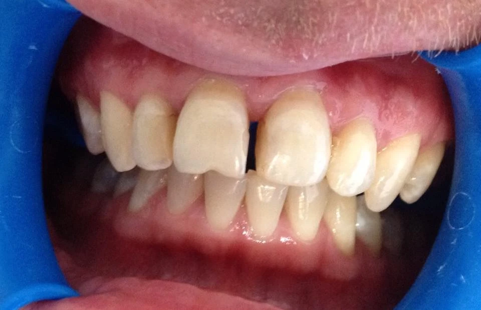 Реставрація з реконструкцією передніх 8 верхніх зубів