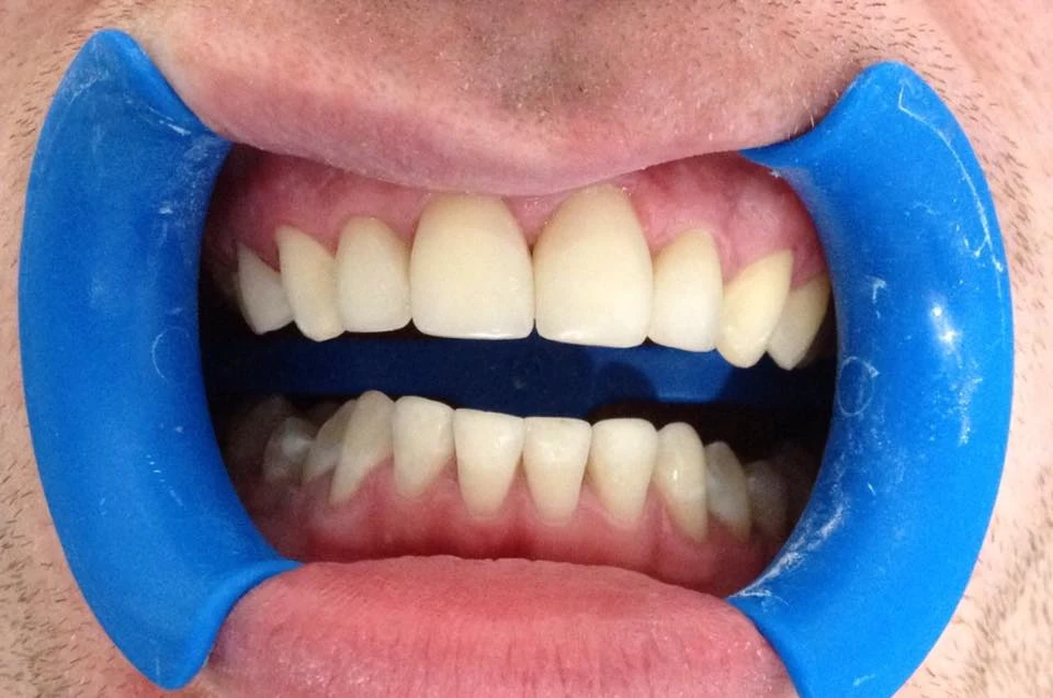 Реставрація з реконструкцією передніх зубів