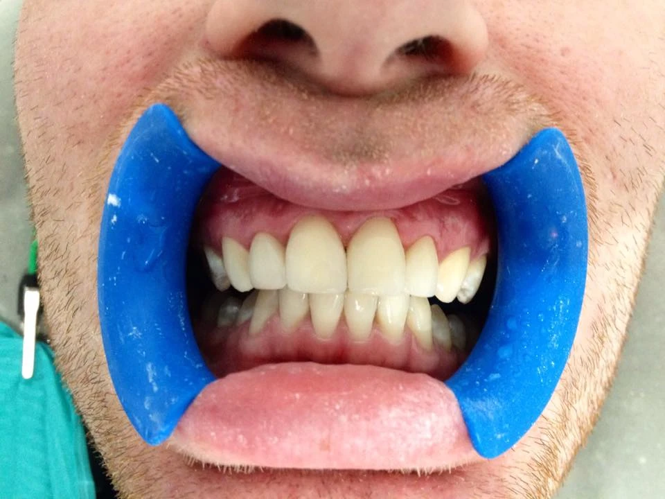 Реставрація з реконструкцією верхніх зубів