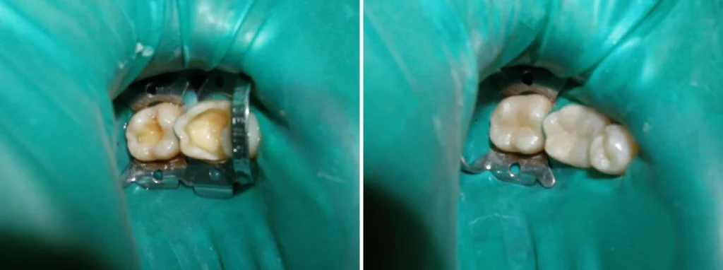 Реставрація нижніх зубів