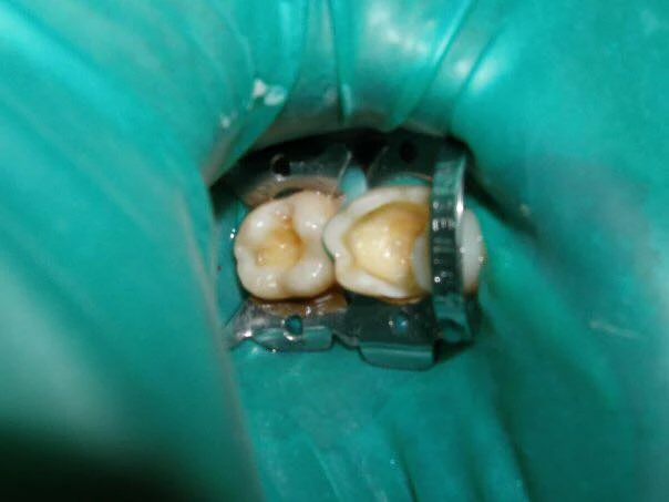 Лікування нижніх зубів