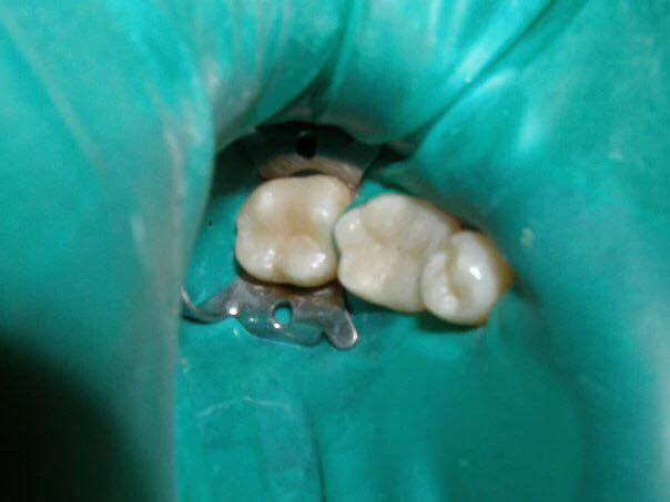 Відновлення нижніх зубів