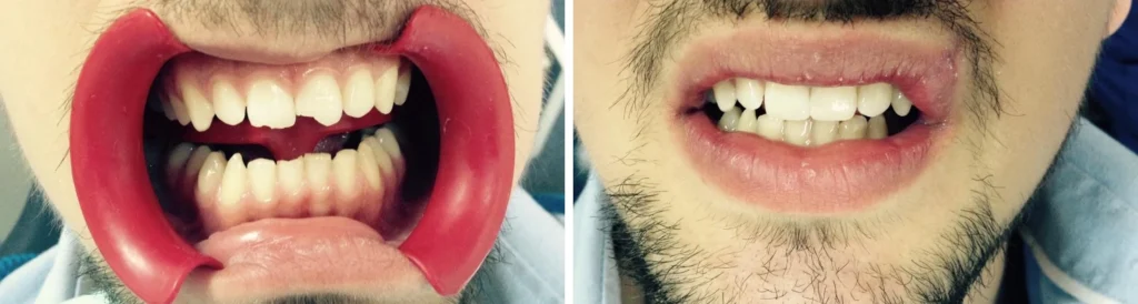 Реставрація передніх зубів після травми