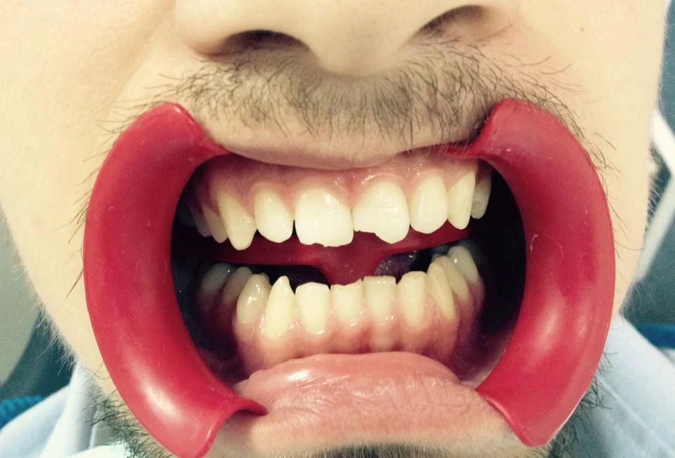 Відновлення передніх зубів після травми