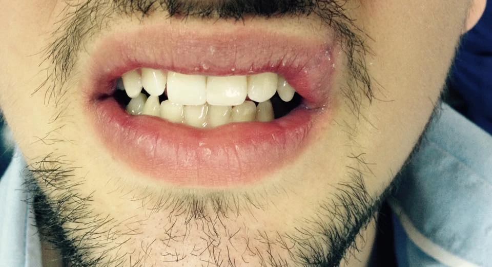 Відновлення зубів після травми