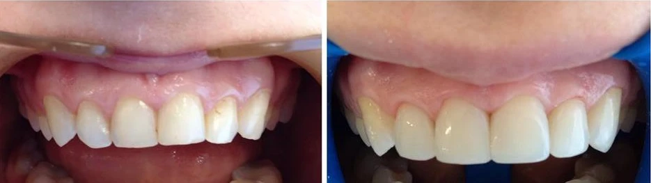 Естетична реставрація зубів