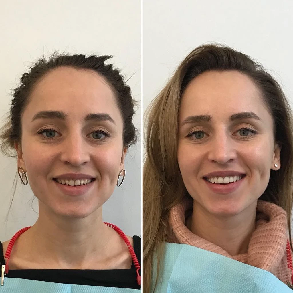 ДО та ПІСЛЯ лікування зубів