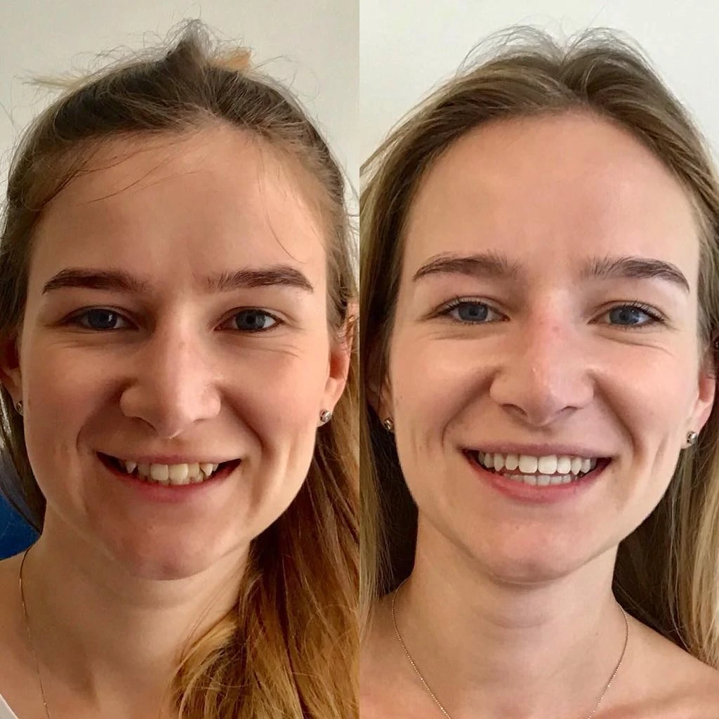 Як БУЛО як СТАЛО після лікування зубів