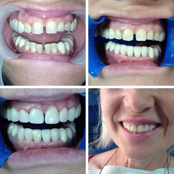 Реставрація верхніх та нижніх зубів