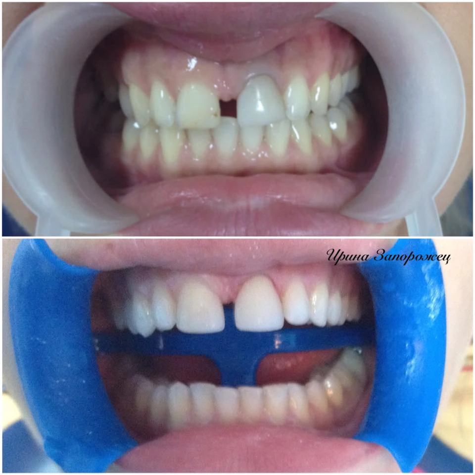 Відбілювання переднього зуба