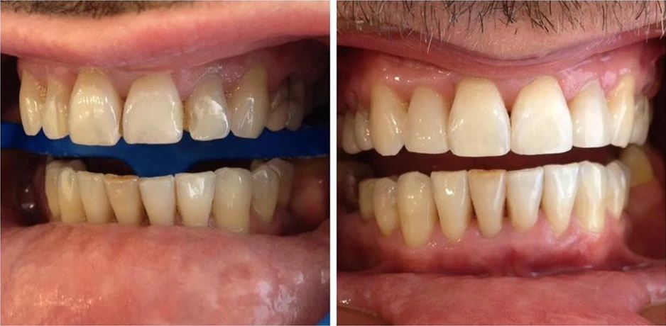 Відбілювання окремих зубів