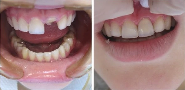 Реставрація переднього зуба