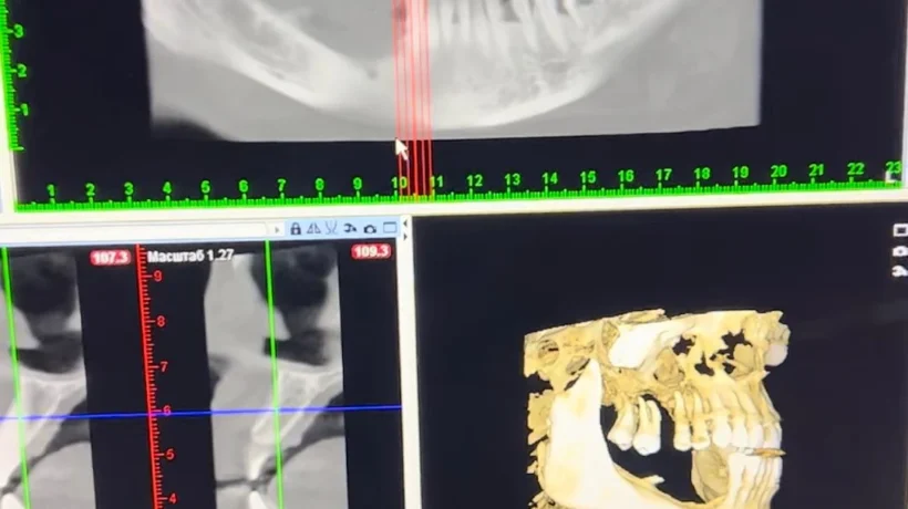 Як зберегти кісткову тканину