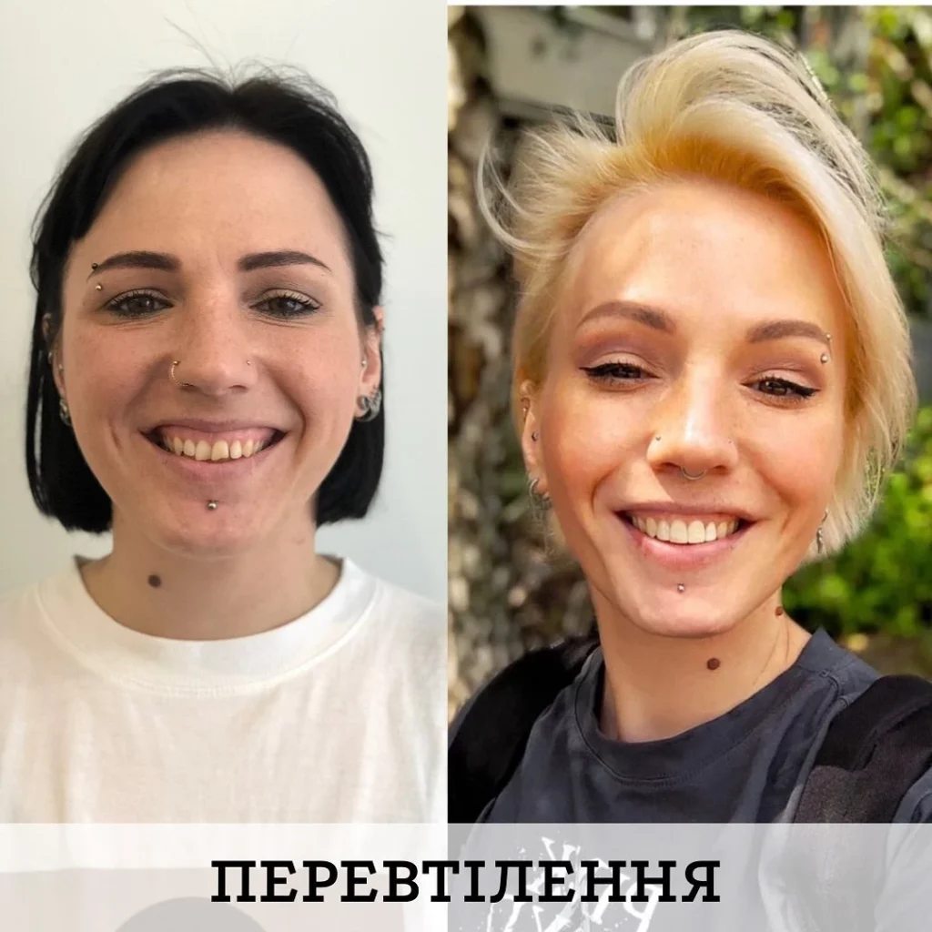 Цифрове встановлення брекет системи