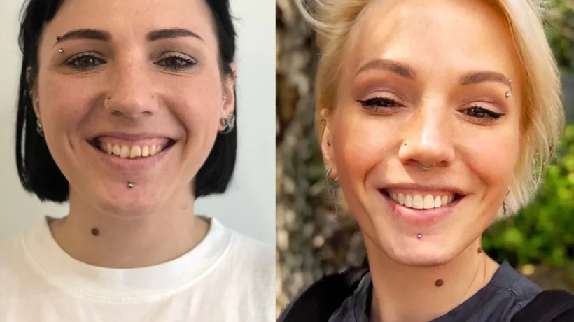 Цифрове встановлення брекет системи