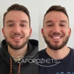 Чи завжди потрібні вініри