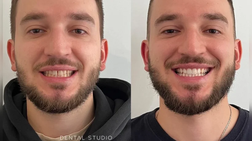 Чи завжди потрібні вініри